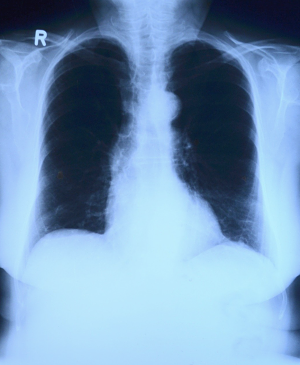 What You Should Know About Chronic Obstructive Pulmonary Disease