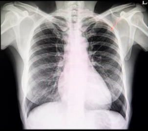 lung nodules CAT scan Pulmonary Associates of Richmond