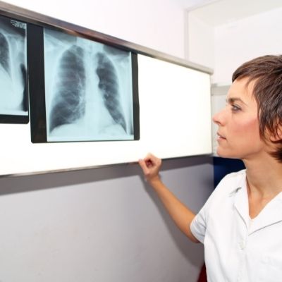 doctor looking at CT scan of pulmonary embolism Pulmonary Associates of Richmond